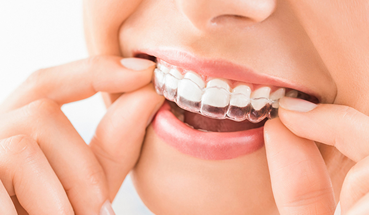 矯正歯科の種類